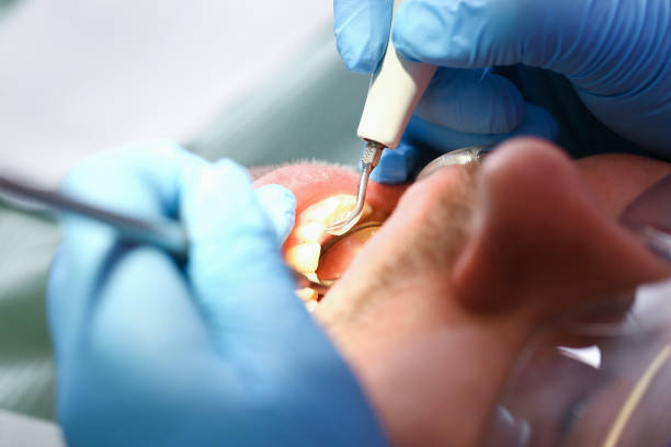 Best Emergency Treatment for Dental Infections or Abscesses in Bradford Woods, PA